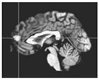Cingulate cortex areas showing altered activity