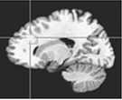 Cingulate cortex areas showing altered activity 