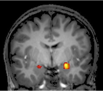 fMRI scan showing amygdala