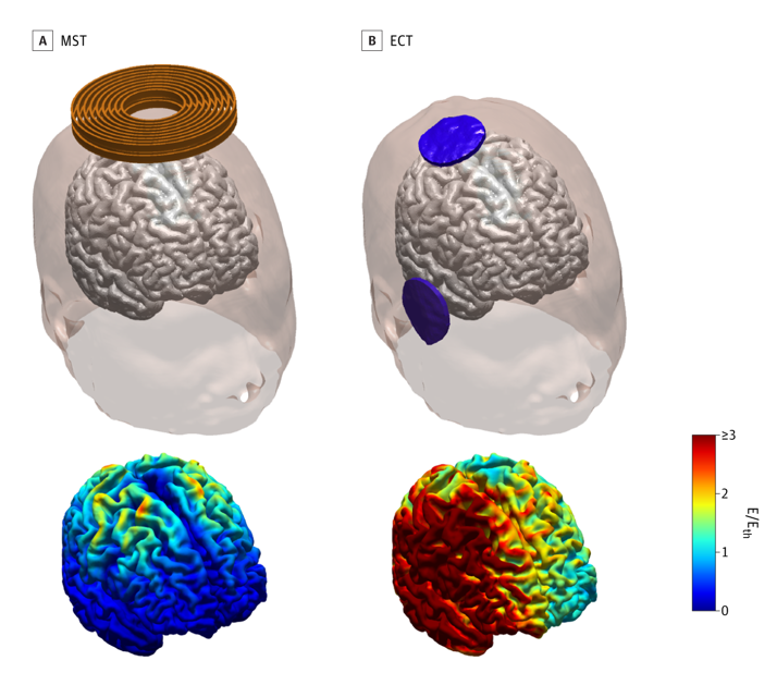 Model of electric field induced in the brain with MST and ECT. Credit: This is an open access article distributed under the terms of the CC-BY license. 2023 Deng ZD et al. JAMA Psychiatry.