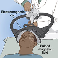 artist depiction of magnetic seizure therapy