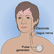artist depiction of vagus nerve stimulation