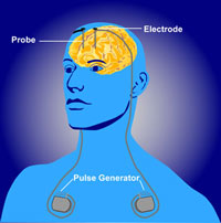 artist depiction of deep brain stimulation