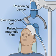 artist depiction of repetitive transcranial magnetic stimulation