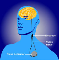 artist depiction of vagus nerve stimulation