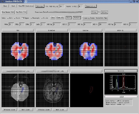 MRS Proton Chemical Shift Imaging of Human Brain Image