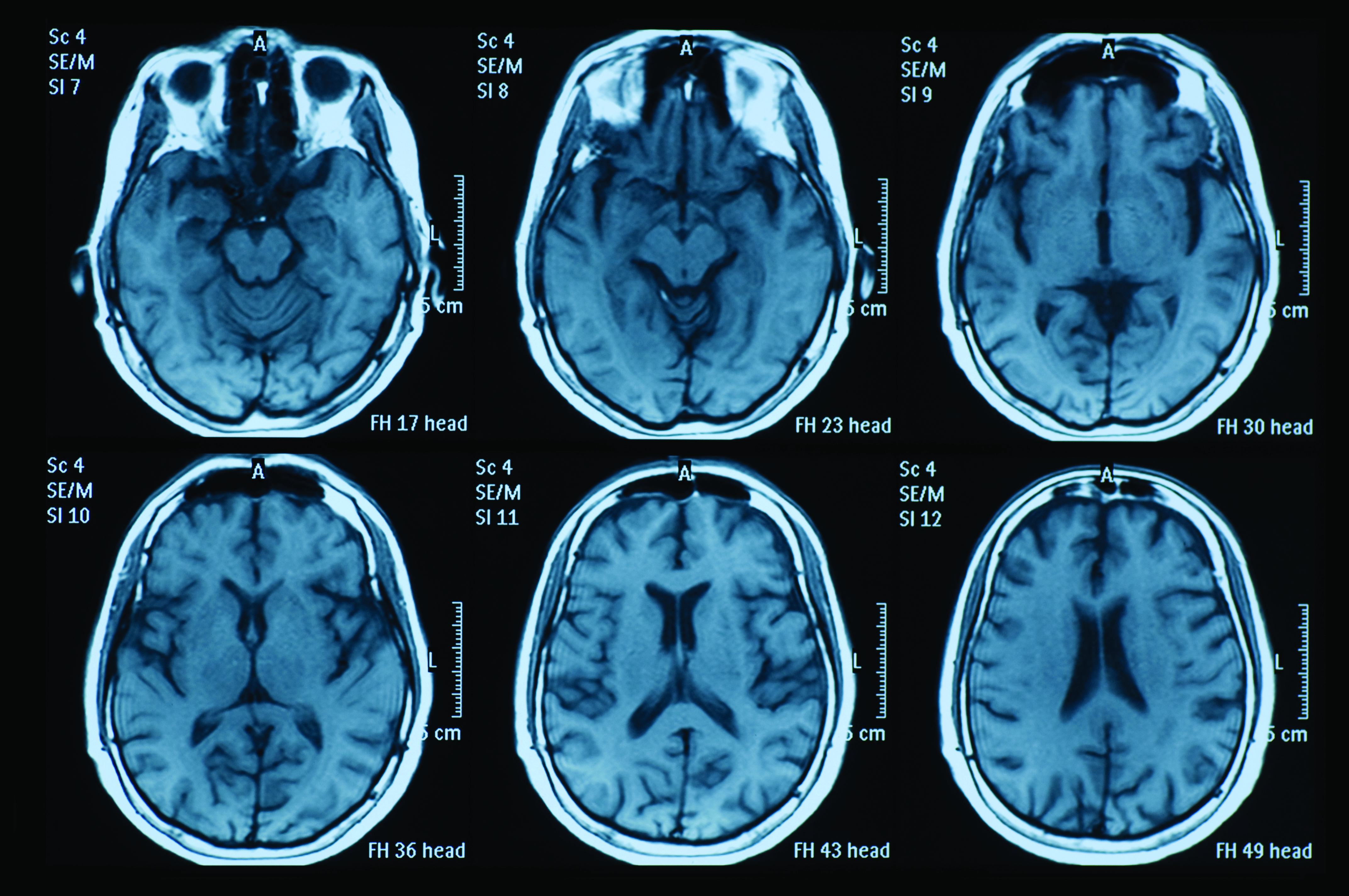 Printout of six MRI brain scans.