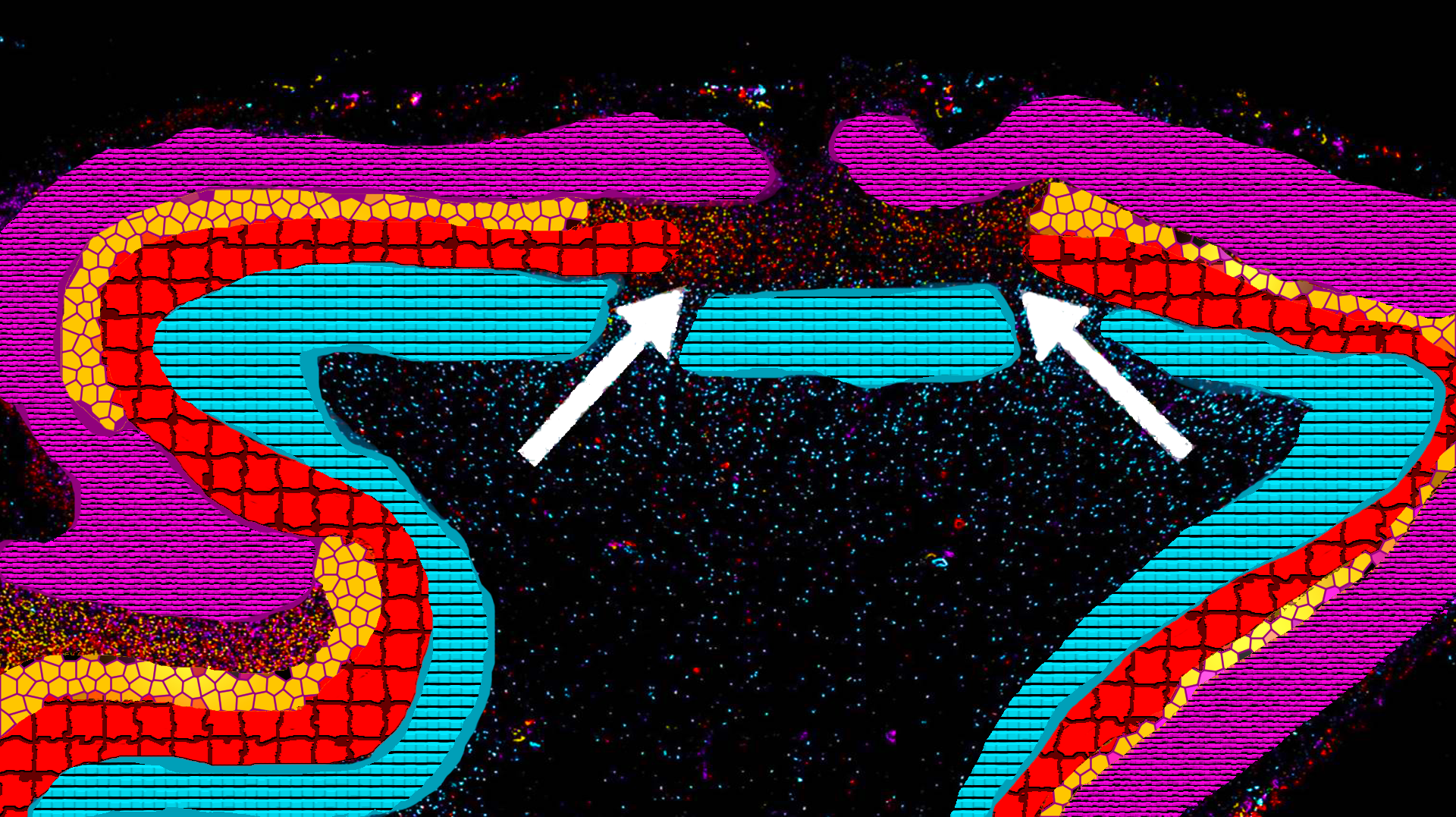 Postmortem analysis of autistic brain tissue revealed patch-like areas of disorganized neurons. Arrows show a patch of decreased or absent expression of genetic markers across multiple layers of the dorsolateral prefrontal cortex.