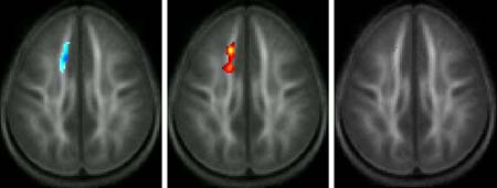 Changes in white matter of poor readers compared to average readers