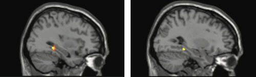 Brain scans reveal that fluctuations in estrogen can trigger atypical functioning in a key brain memory circuit in women with a common version of a gene.