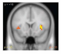 Brain activity during investment game in healthy participants compared with participants with borderline personality disorder