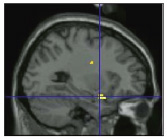 Amygdala activation