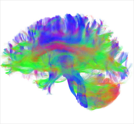 Diffusion image shows long distance connections in brain of study participant.