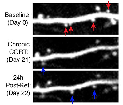 Images of dendritic spine remodeling. Images taken at baseline, after exposure to a stressor (Chronic CORT), and after a single dose of ketamine. Credit: Reprinted with permission from Conor Liston, Science (2019)