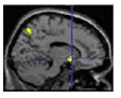 Brain activity associated with the inability to experience pleasure