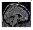 Depression-related hot spot of brain activity