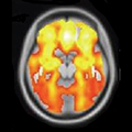 Biotypes MRI