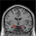 An fMRI image of the brain showing two small red areas that represent the amygdala, as defined functionally by the researchers.