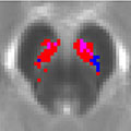 MRI image displays a map of substantia nigra voxels where NM-MRI signal was positively correlated with severity of psychotic symptoms.