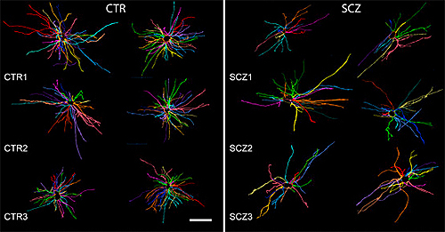 Astrocytes from patients and normal controls