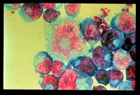 HIV infected T cells