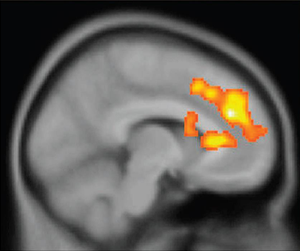 Dorsal anterior cingulate cortex