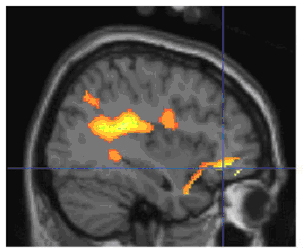 increased activity in emotion processing circuit