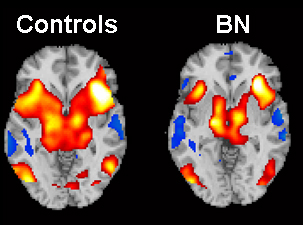 fMRI data showing self-regulatory brain activity in healthy controls and women with bulimia