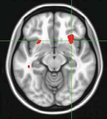 Mayberg right anterior insula