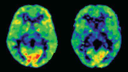 SERT and PTSD symptoms