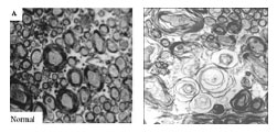 normal and abnormal axons