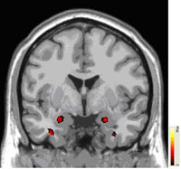 Higher grey matter in Amygdala in BPD