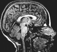MRI scan image of a 13-year-old
