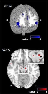 prefrontal cortex-basal ganglia circuit links schizophrenia and psychosis