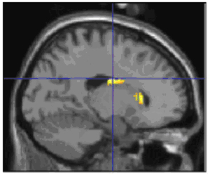 Increased activity in emotion processing circuit