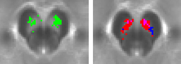 The image on the left displays a map of substantia nigra voxels where NM-MRI signal positively correlated with PET measures of dopamine release capacity (denoted in green). The image on the right displays a map of substantia nigra voxels where NM-MRI signal was positively correlated with severity of psychotic symptoms (individuals with schizophrenia shown in red; clinical high risk individuals shown in blue; the overlap between both groups show in pink). Credit: Dr. Guillermo Horga