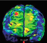 Childhood bedwetting linked to reduced gray matter in the front of the brain (red areas).