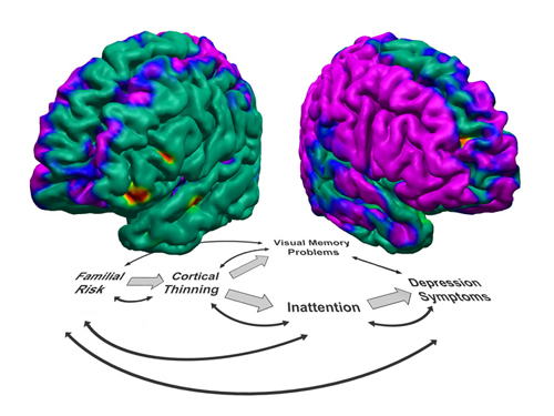 MRI brain map of tissue thickness with proposed disorder model