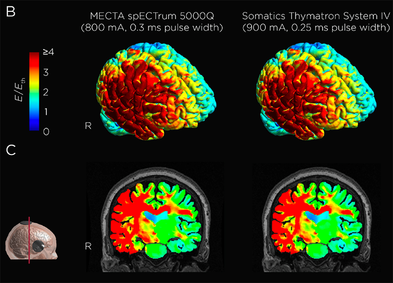 Combined Electroconvulsive Therapy and Venlafaxine a Well-Tolerated Depression Treatment for Older Adults