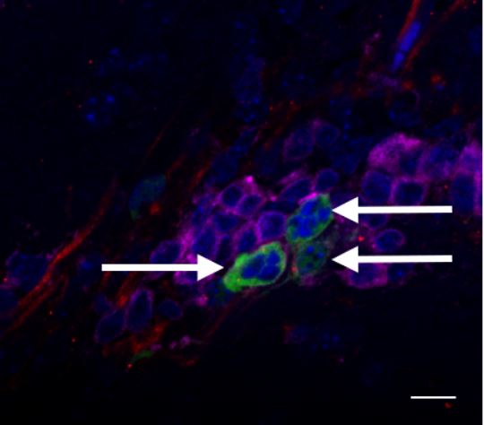 Image showing HIV infection of CD4+ T cells in the mouse brain. Human T cells (magenta), human astrocytes (red), HIV (green), nuclei (Blue). Arrows identify uptake of HIV from astrocytes into T cells. Credit: Al-Harthi et al. (2020).